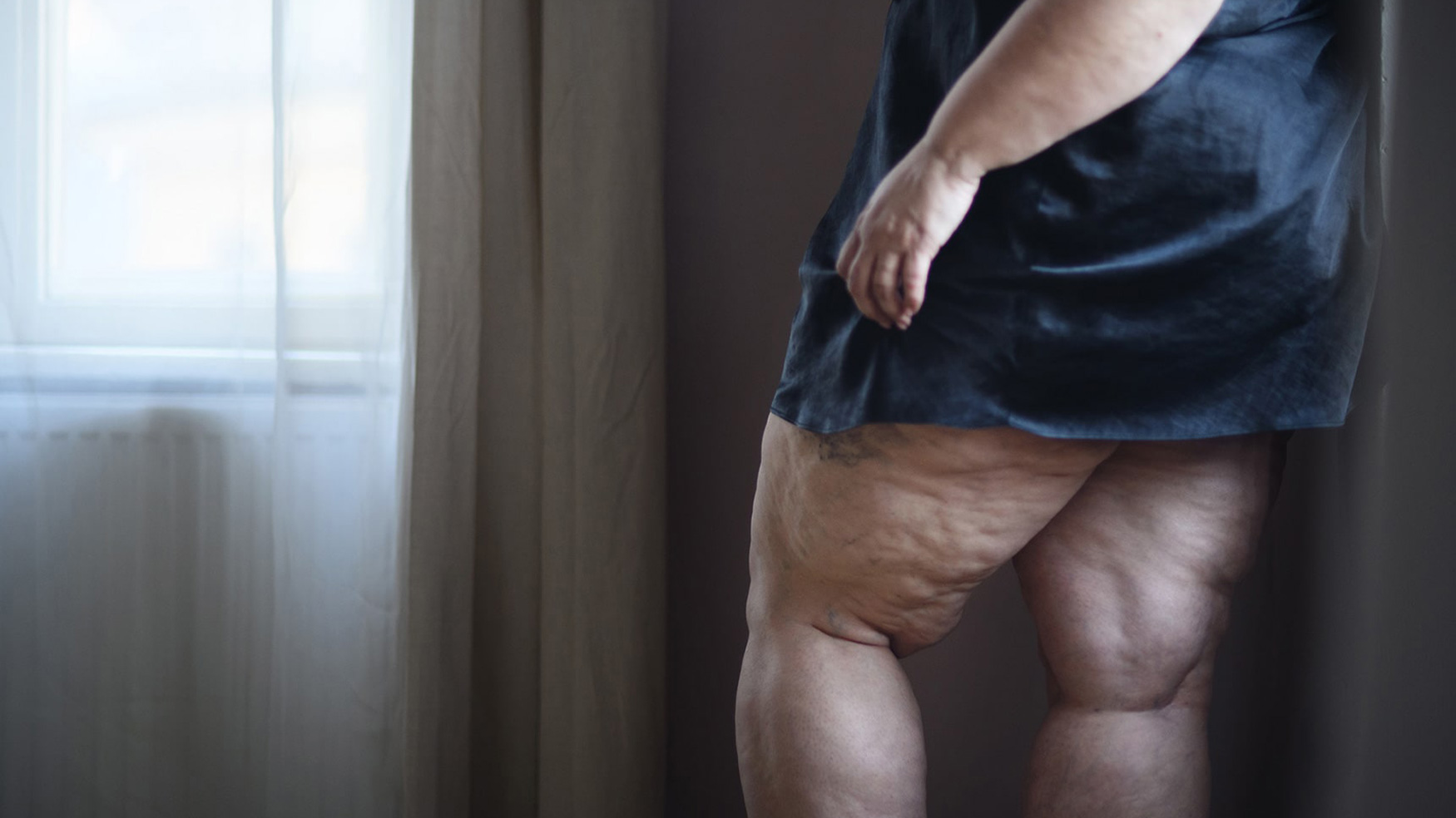 CELL NEA: Especialistas en Linfedema y Lipedema